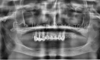 Восстановление зубов на верхней и нижней челюсти - Фотография 3